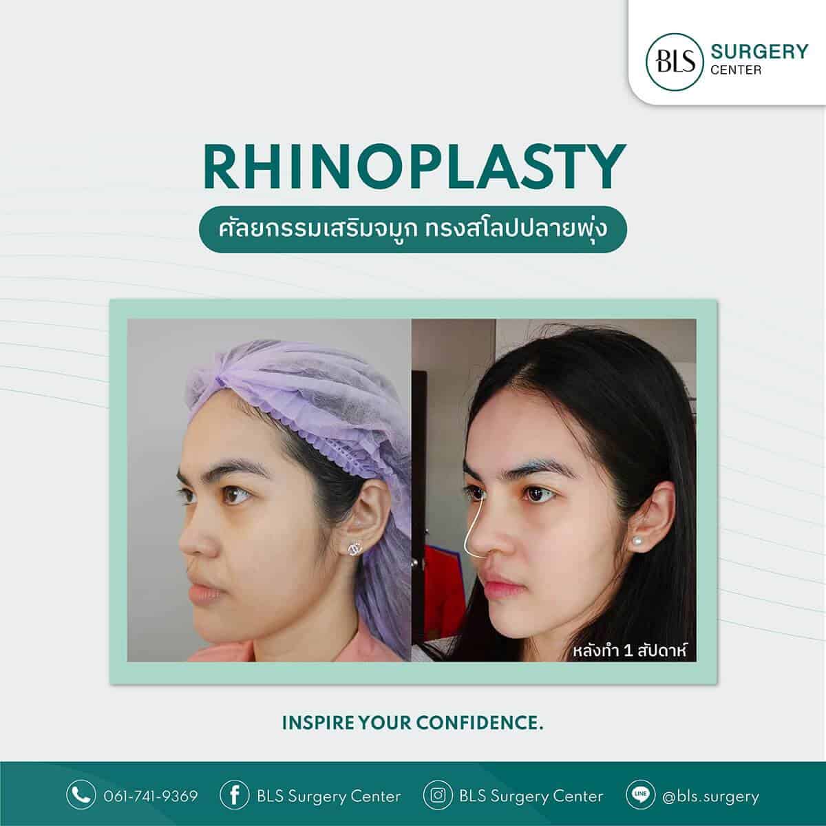 Review ศัลยกรรมเสริมจมูก (Rhinoplasty)