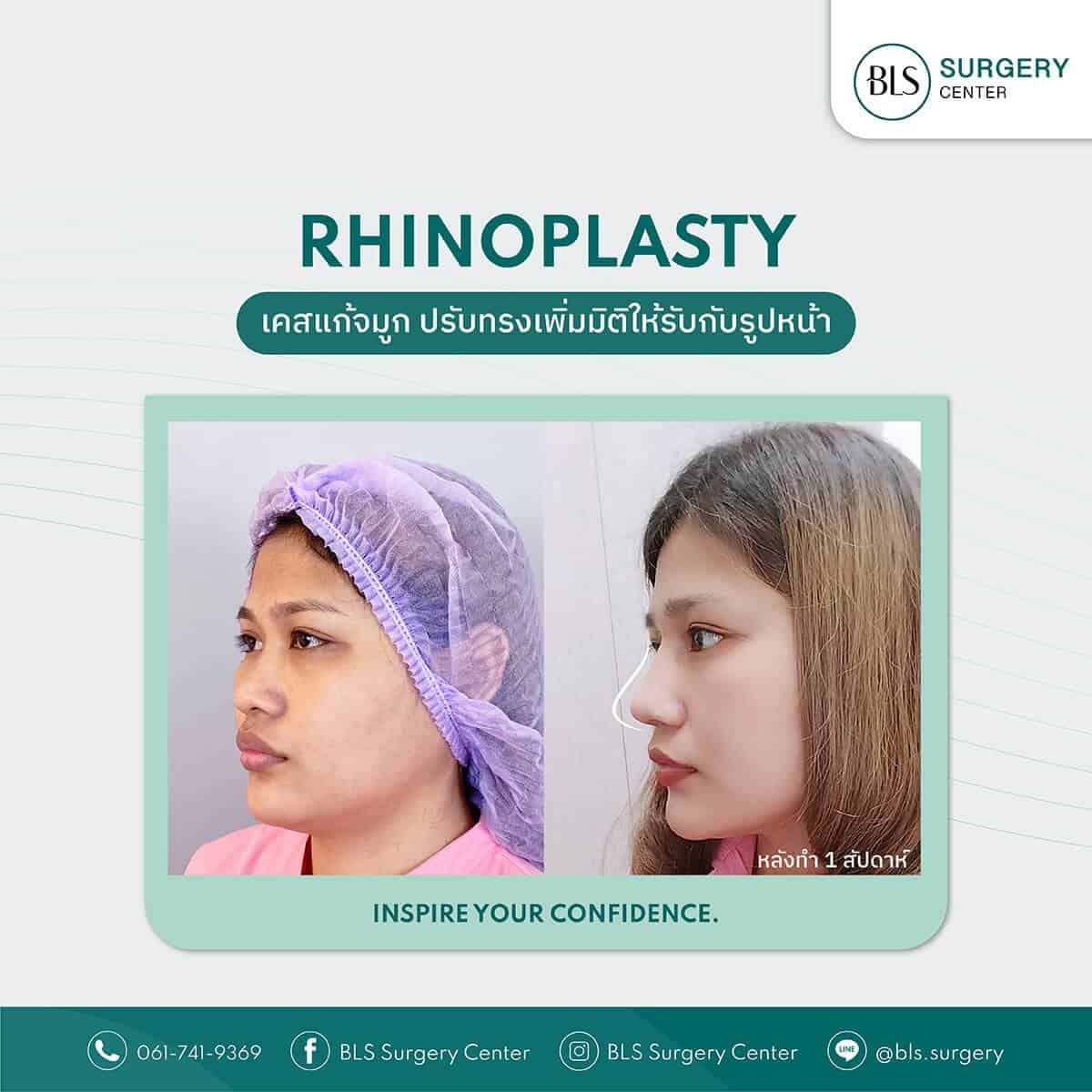 Review ศัลยกรรมเสริมจมูก (Rhinoplasty)