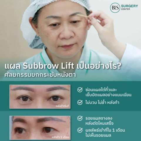 รีวิวศัลยกรรมแก้หนังตาตก (Subbrow Lift)