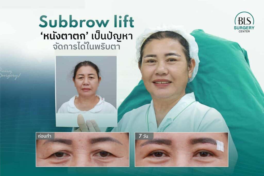 แผลหลังการผ่าตัด Sub brow Lift