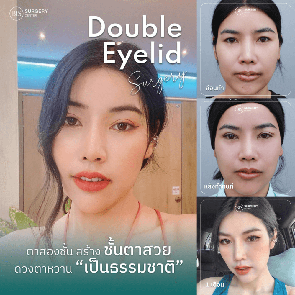 ศัลยกรรมตาสองชั้น (Double Eyelid)