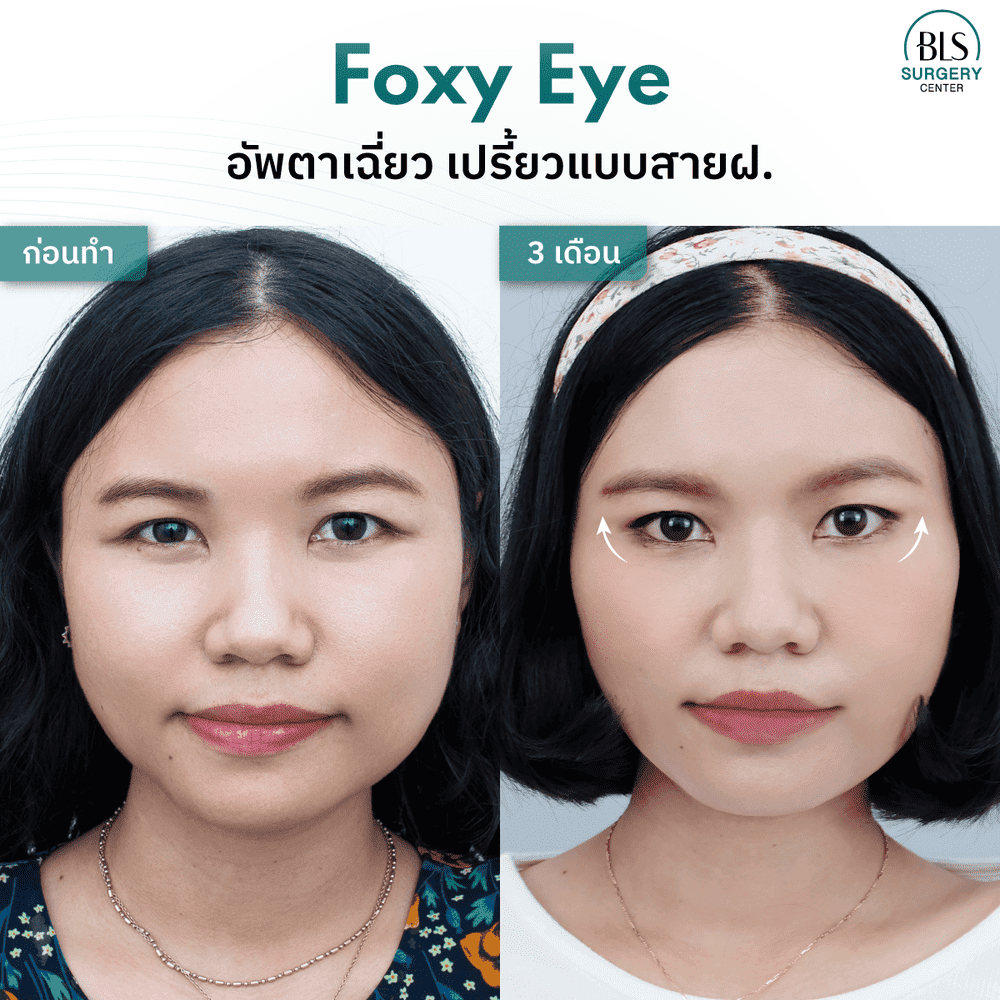 รีวิวศัลยกรรมยกหางตา(Foxy Eyes)