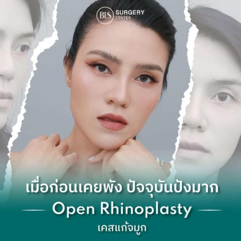 รีวิวศัลยกรรมเสริมจมูก (Rhinoplasty)
