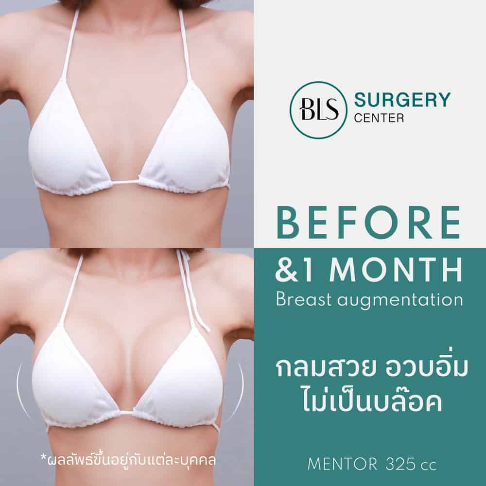 ศัลยกรรมเสริมหน้าอก (Breast Augmentation)