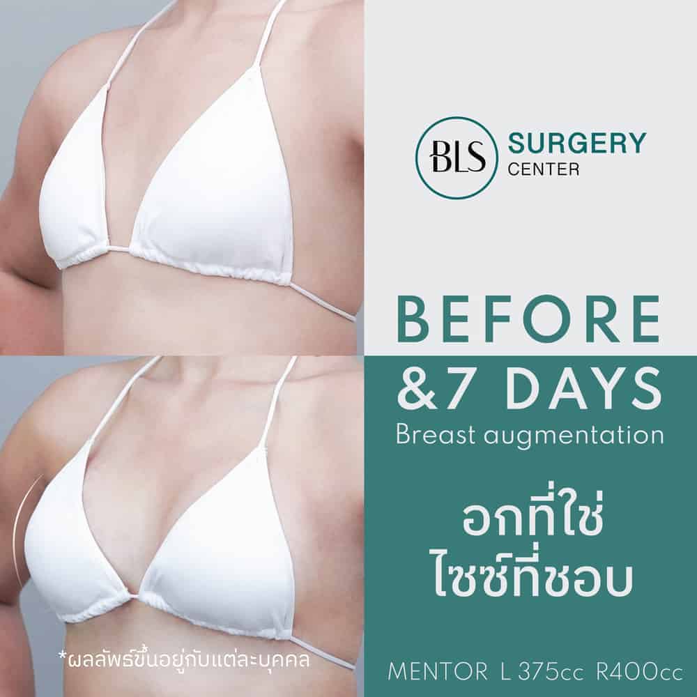 ศัลยกรรมเสริมหน้าอก (Breast Augmentation)