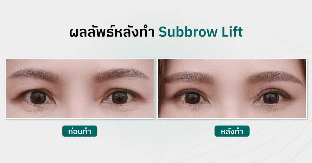 แก้ปัญหาหนังตาตก เหมาะกับใคร และผลลัพธ์หลังทำ subbrow Lift