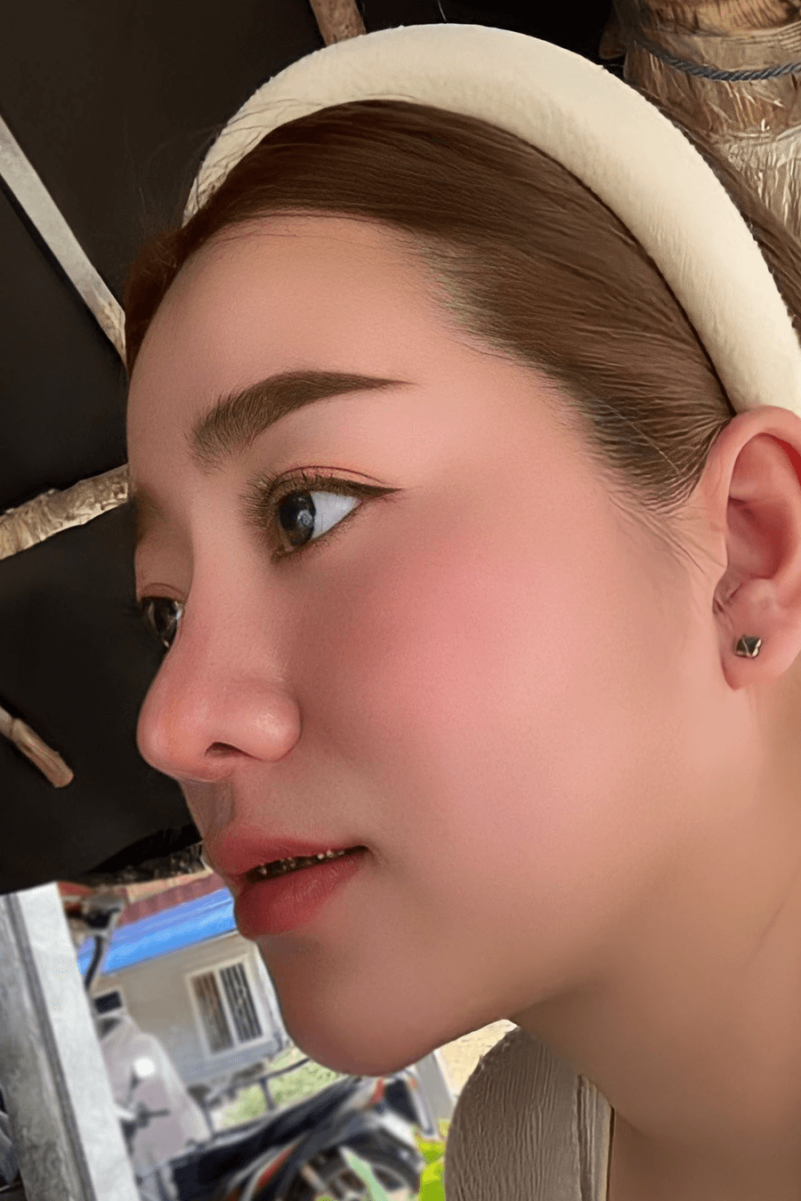 หลังเสริมจมูก และเสริมคาง ทรงจมูกสโลป ปลายพุ่ง คางสวยเป็นธรรมชาติ