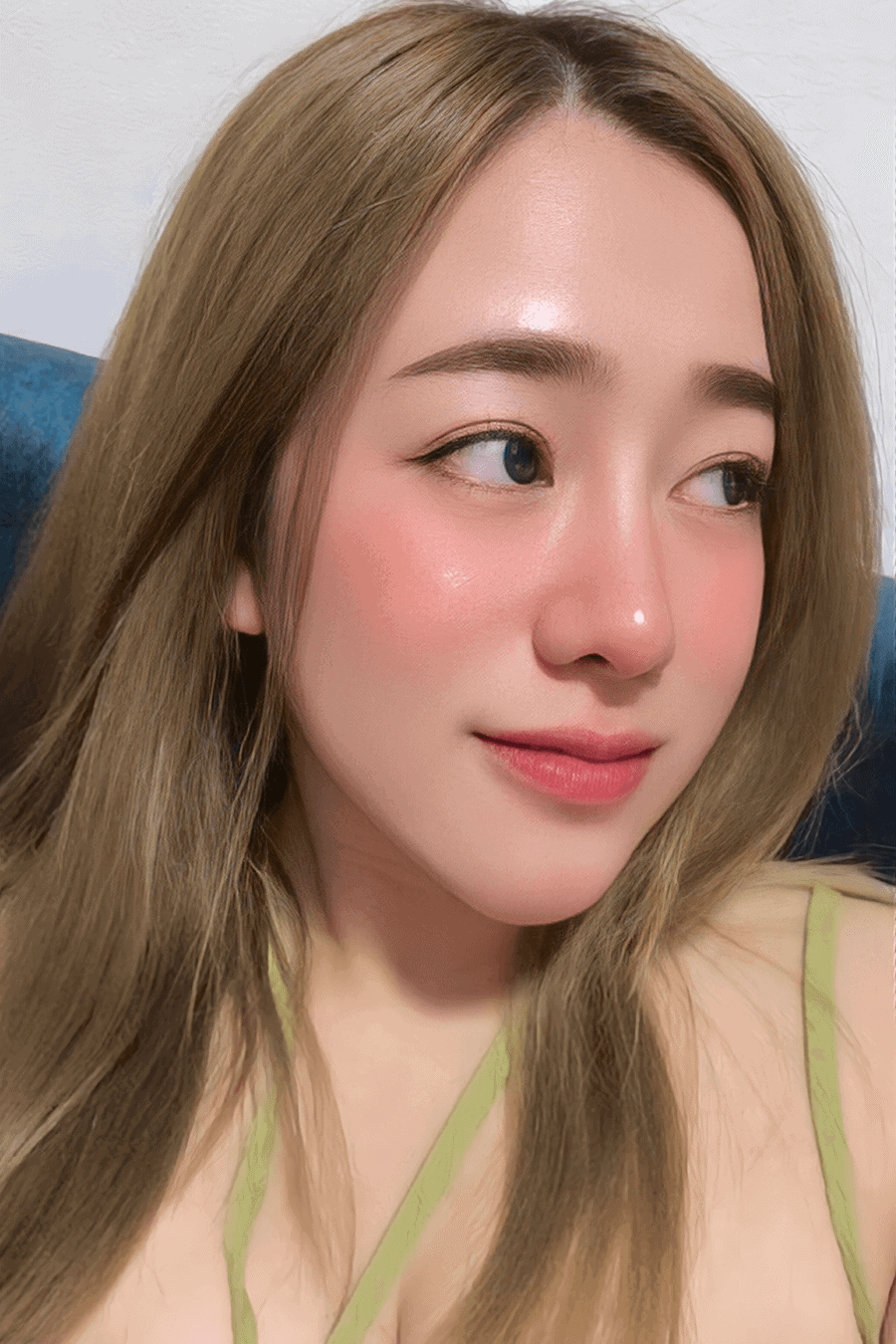 หลังเสริมจมูก และเสริมคาง ทรงจมูกสโลป ปลายพุ่ง คางสวยเป็นธรรมชาติ