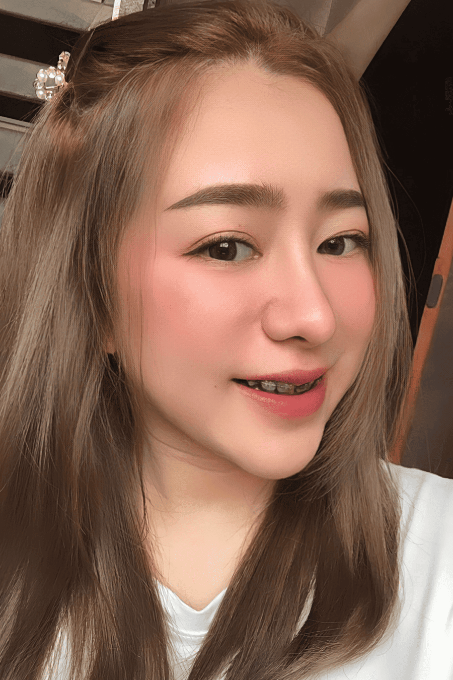หลัง เสริมจมูกแบบโอเพ่น และเสริมคาง ทรงจมูกสโลป ปลายพุ่ง คางสวยเป็นธรรมชาติ