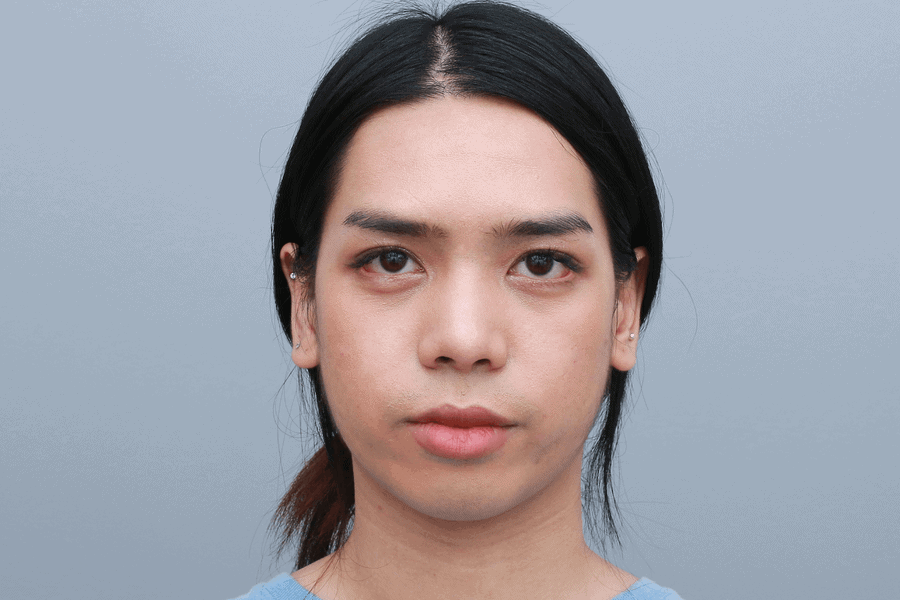 รีวิวเสริมคาง เสริมจมูก ทำตาสองชั้น ยกคิ้ว ก่อนทำ | เสริมคางที่ไหนดี