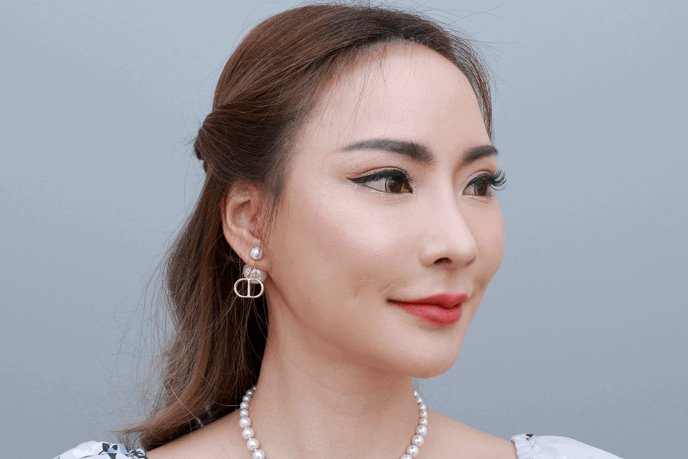 หลัง Facelift ดึงหน้า 1 เดือน