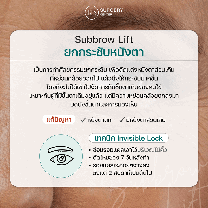 ยกกระชับหนังตา Subbrow Lift