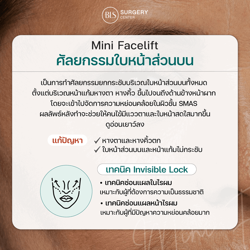 ศัลยกรรมใบหน้าส่วนบน Mini Facelift