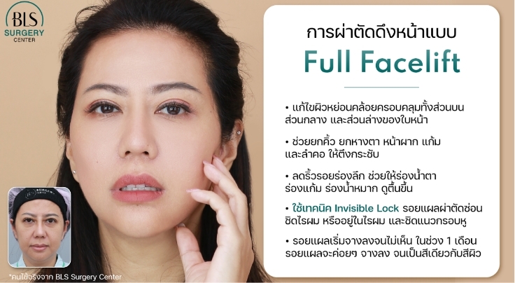 การผ่าตัดดึงหน้าแบบ Full Facelift