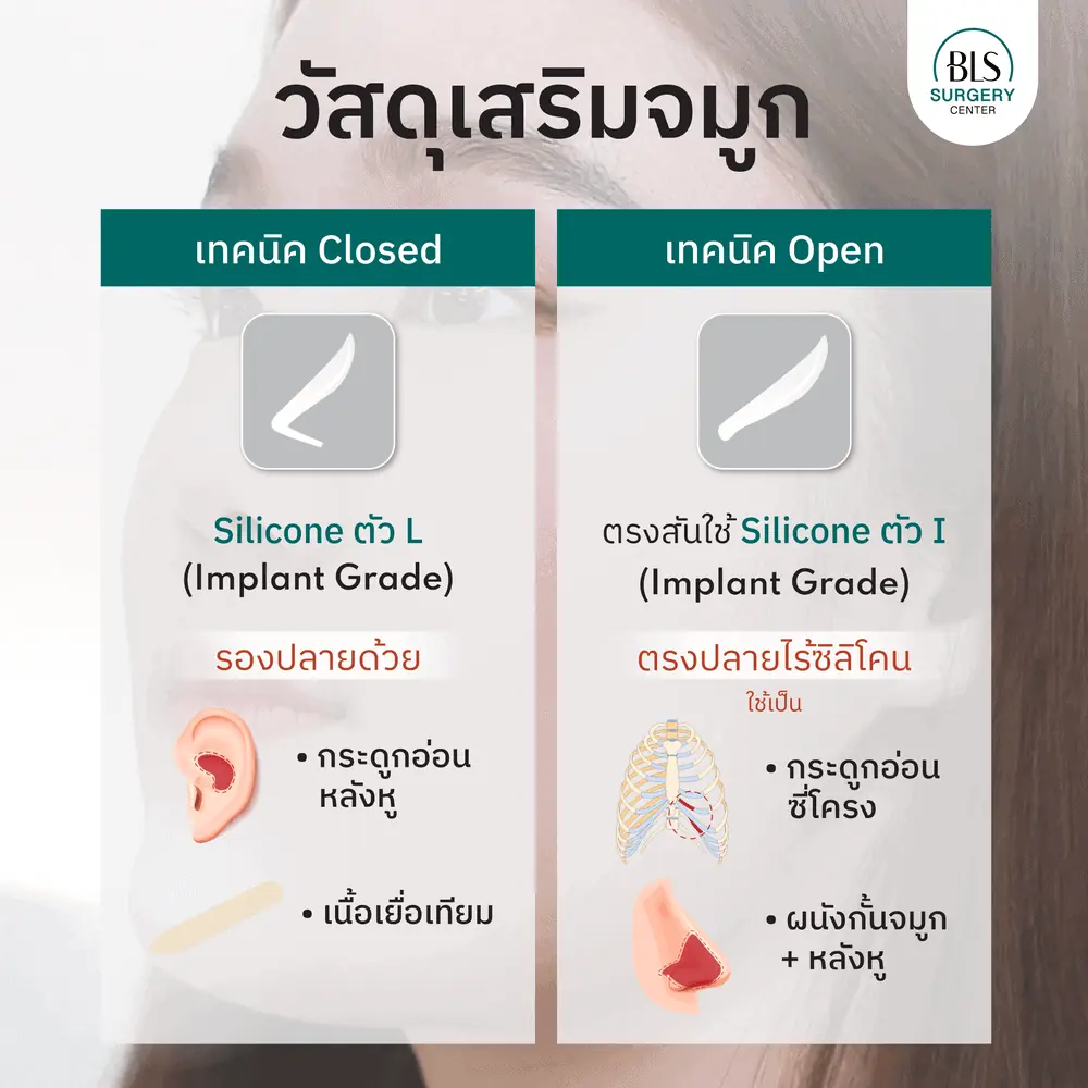 วัสดุเสริมจมูกเทคนิค Closed VS เสริมจมูกแบบโอเพ่น 