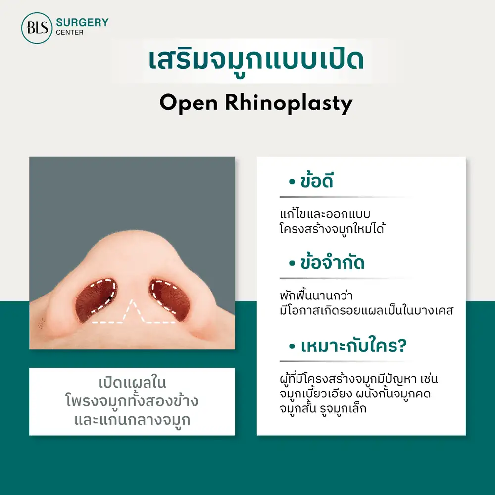 เสริมแบบเปิด (Open Rhinoplasty)