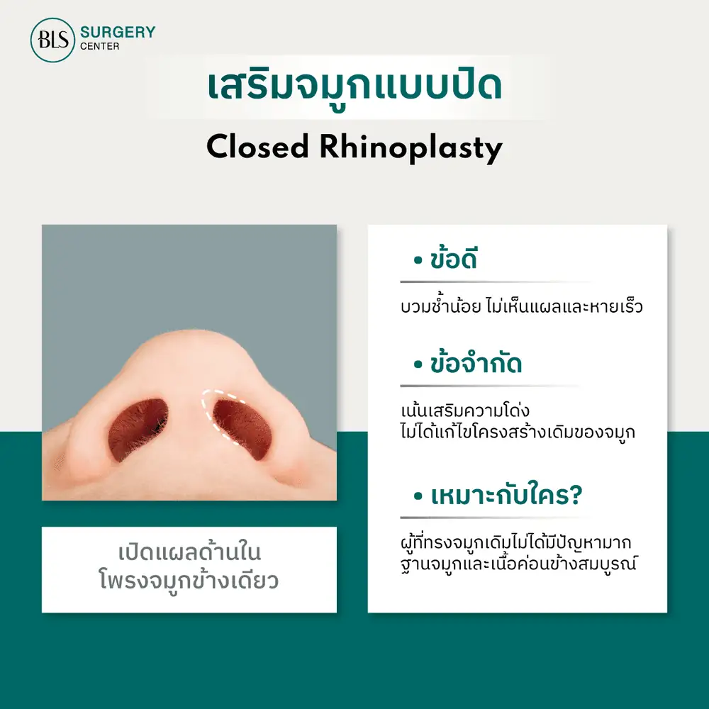 เสริมแบบปิด (Close Rhinoplasty)