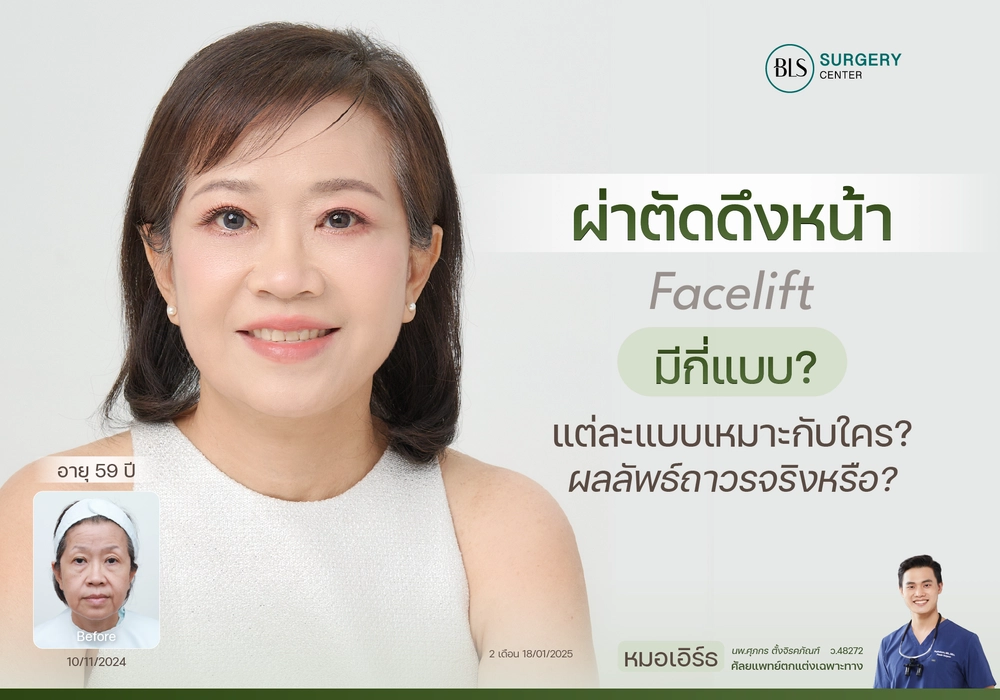 ผ่าตัดดึงหน้า คืออะไร มีกี่แบบ แบบไหนเหมาะกับใคร ผลลัพธ์คงอยู่ถาวรจริงหรือ?