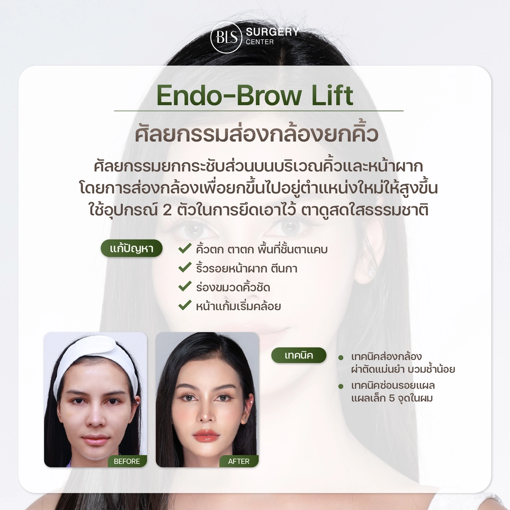 การส่องกล้องยกคิ้ว Endo-Brow Lift