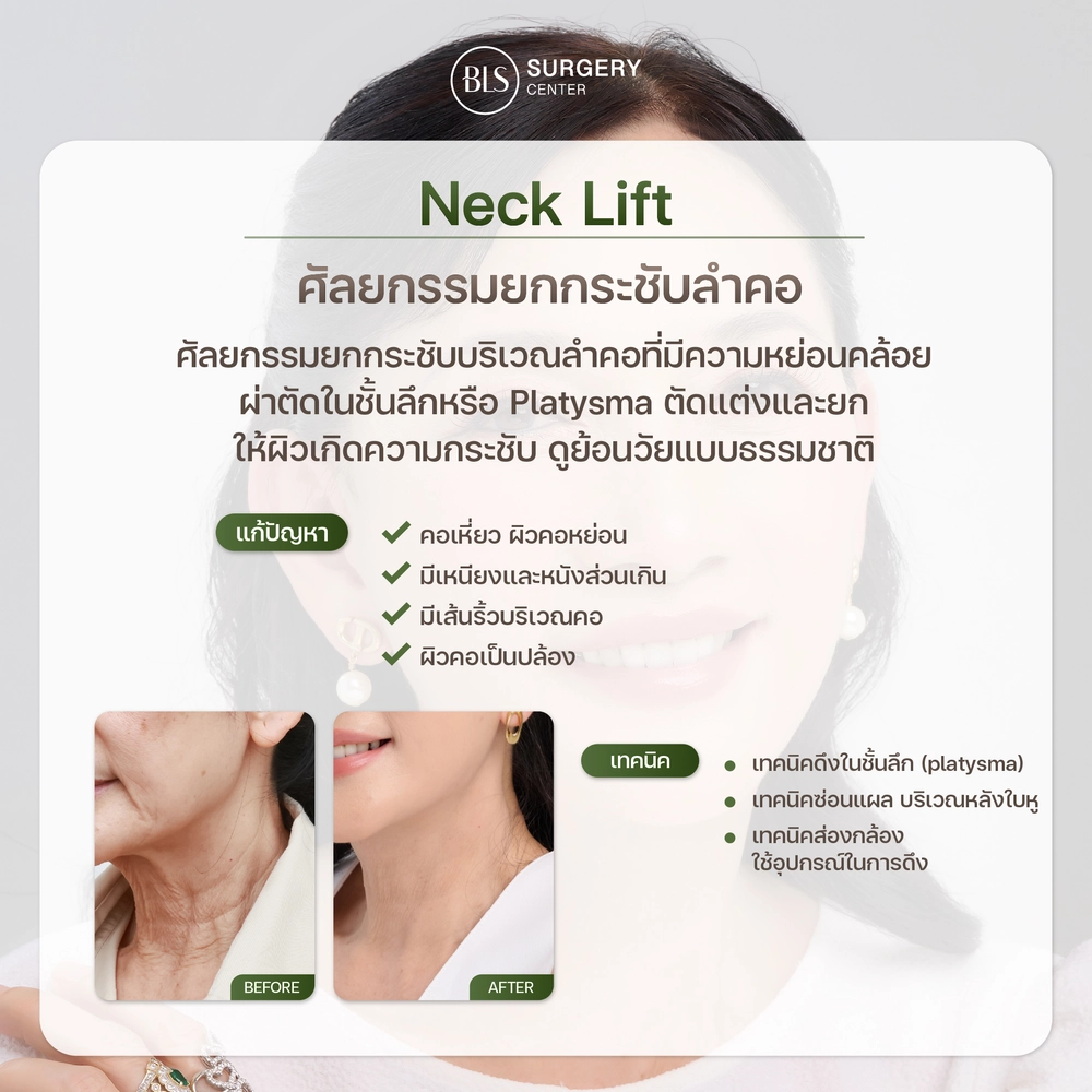 การผ่าตัดยกกระชับลำคอ (Neck Lift)