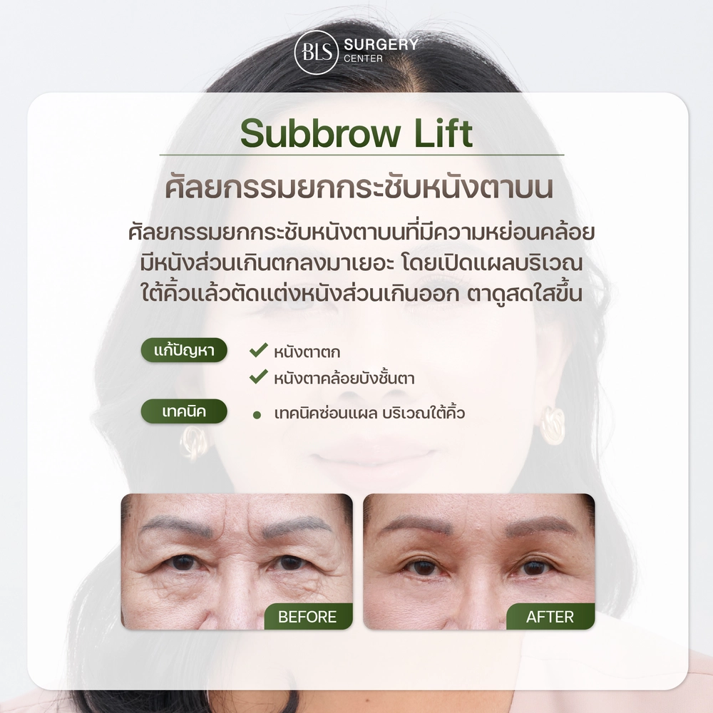 การผ่าตัดยกกระชับหนังตา (Subbrow Lift)