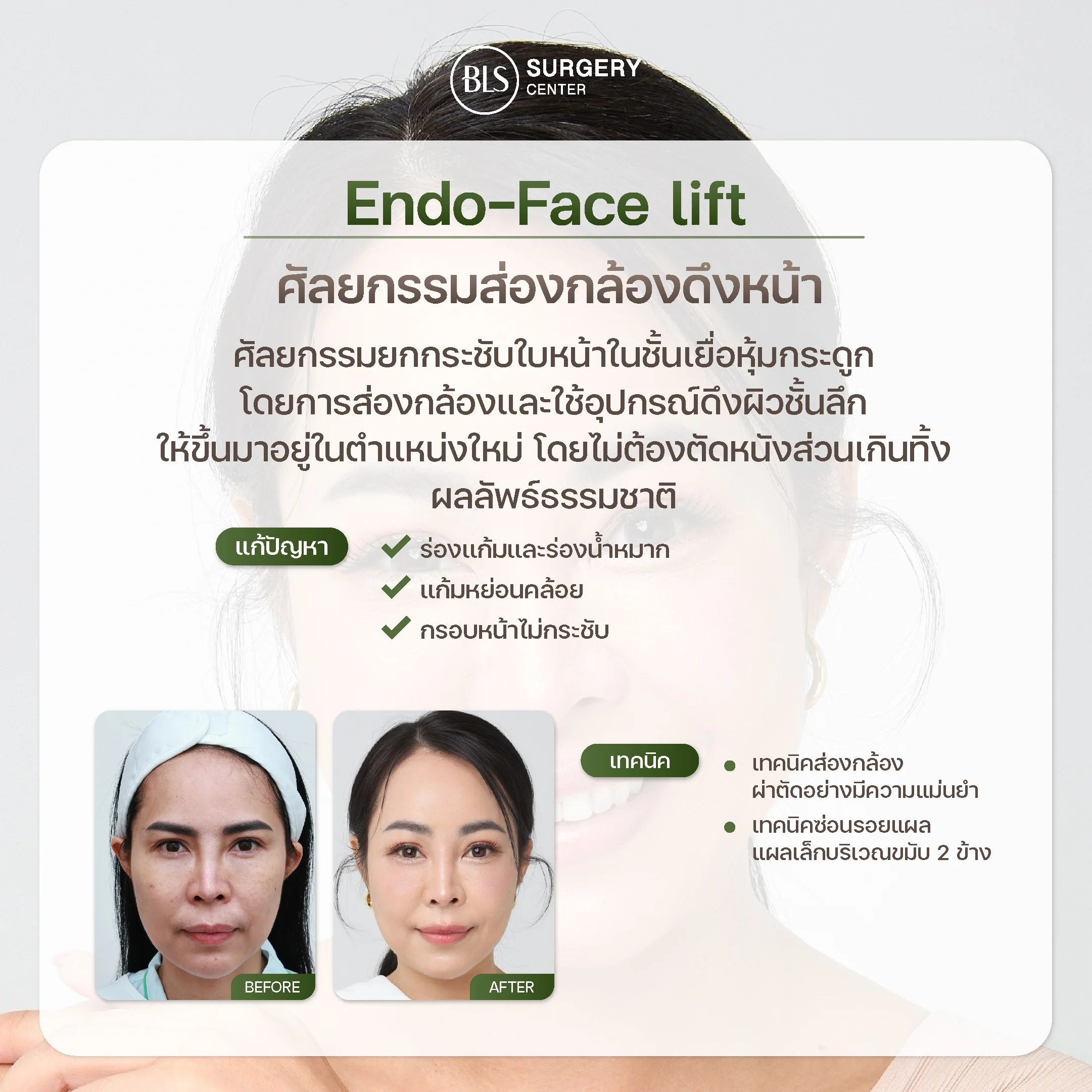การส่องกล้องดึงหน้า Endo-Face Lift