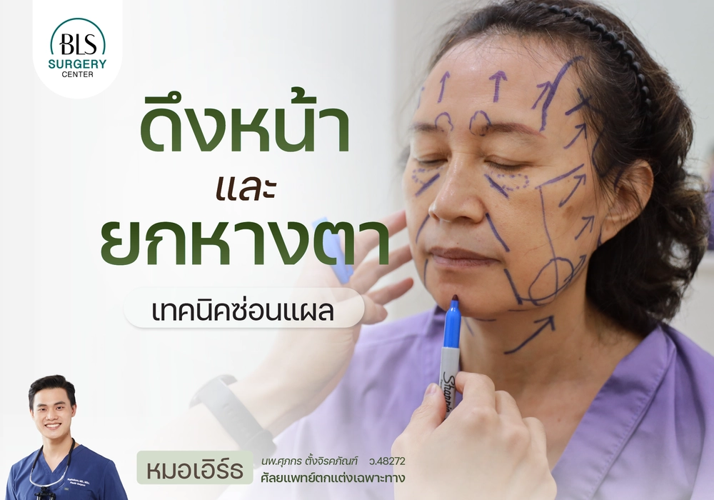 ผ่าตัดยกหางตา และดึงหน้า เทคนิคซ่อนแผล Invisible lock