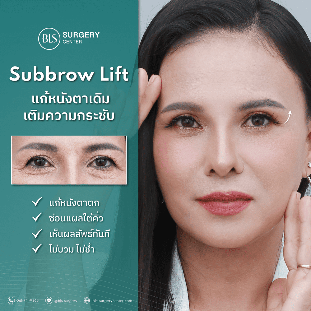 ศัลยกรรมแก้หนังตาตก (Subbrow Lift)