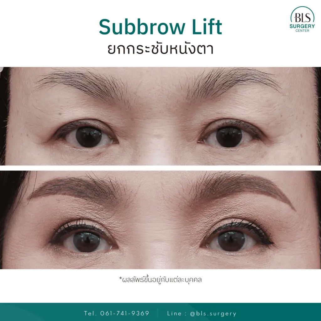 ชมรีวิวแก้หนังตาตก ด้วยการทำ Sub brow Lift เทคนิคเฉพาะ BLS Surgery Center