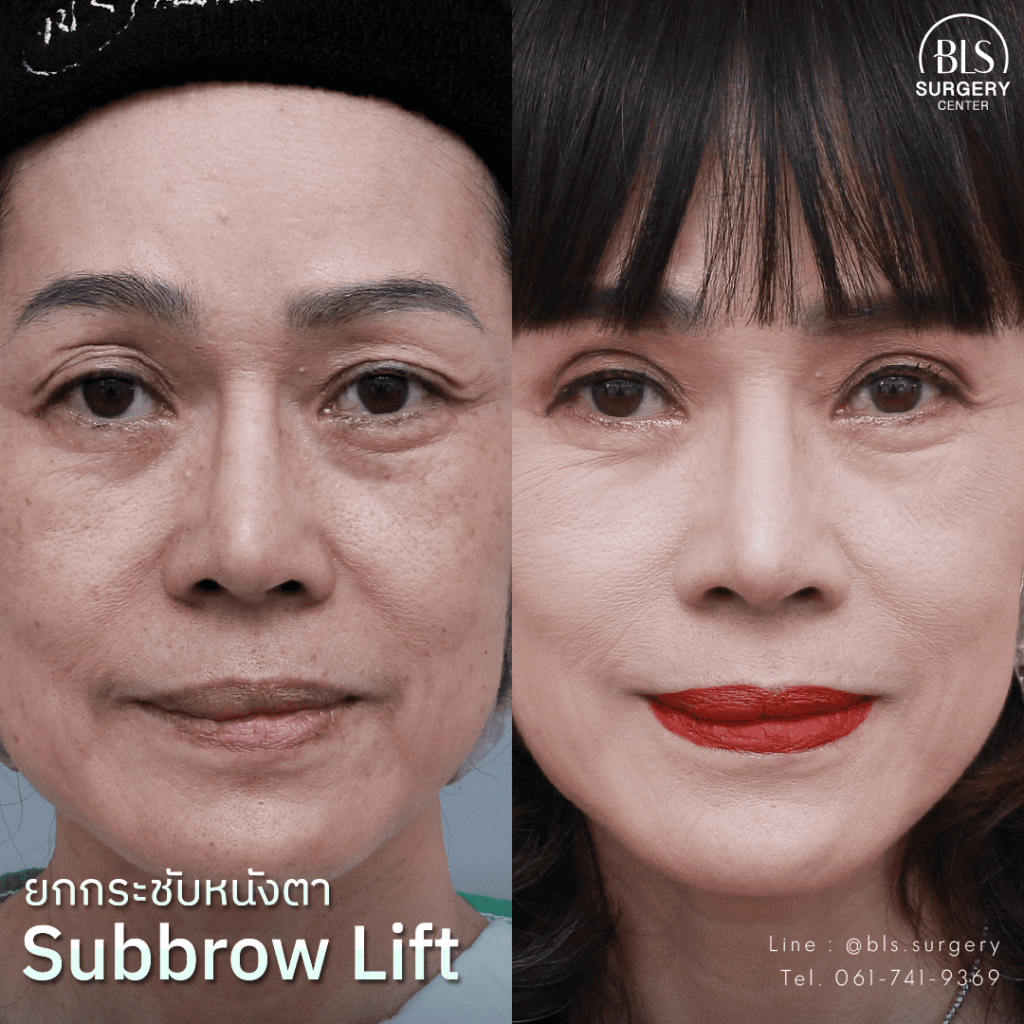 ชมรีวิว แก้หนังตาตก ด้วยการทำ Sub brow Lift เทคนิคเฉพาะ BLS Surgery Center