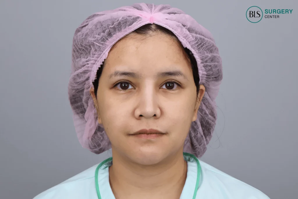 Before Foxy Eyes – Drooping Brows, Drooping Outer Corners, Sad, Dull Eyes