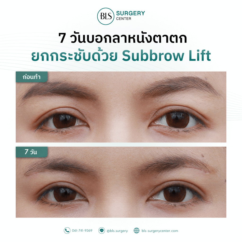 ชมรีวิวแก้หนังตาตก ด้วยการทำ Sub brow Lift เทคนิคเฉพาะ BLS Surgery Center