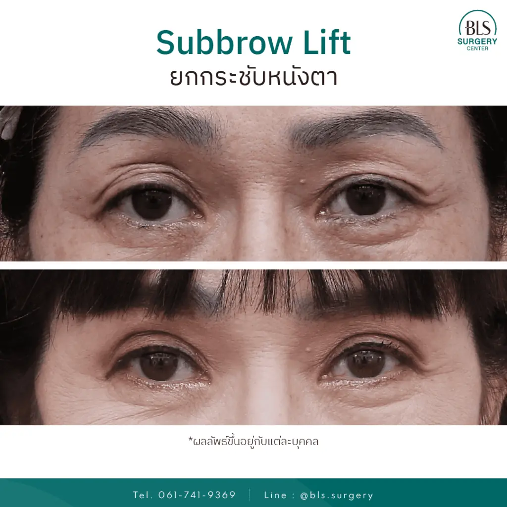 ชมรีวิว แก้หนังตาตก ด้วยการทำ Sub brow Lift เทคนิคเฉพาะ BLS Surgery Center