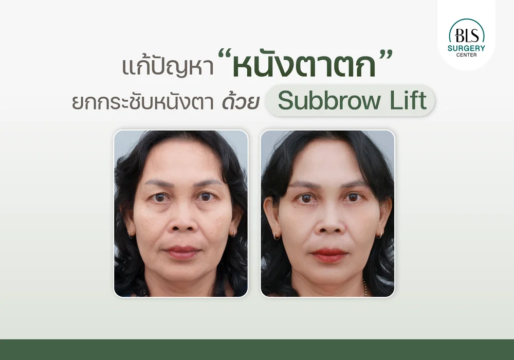 แก้หนังตาตก ยกกระชับหนังตา ด้วย Subbrow Lift