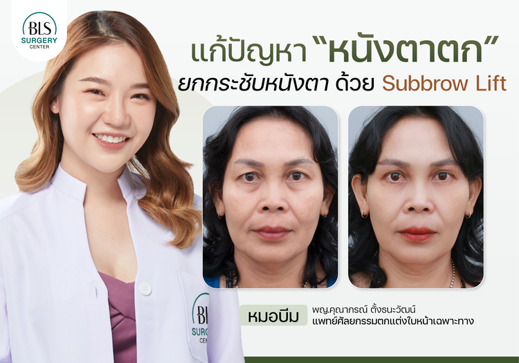 แก้หนังตาตก ยกกระชับหนังตา ด้วย Subbrow Lift