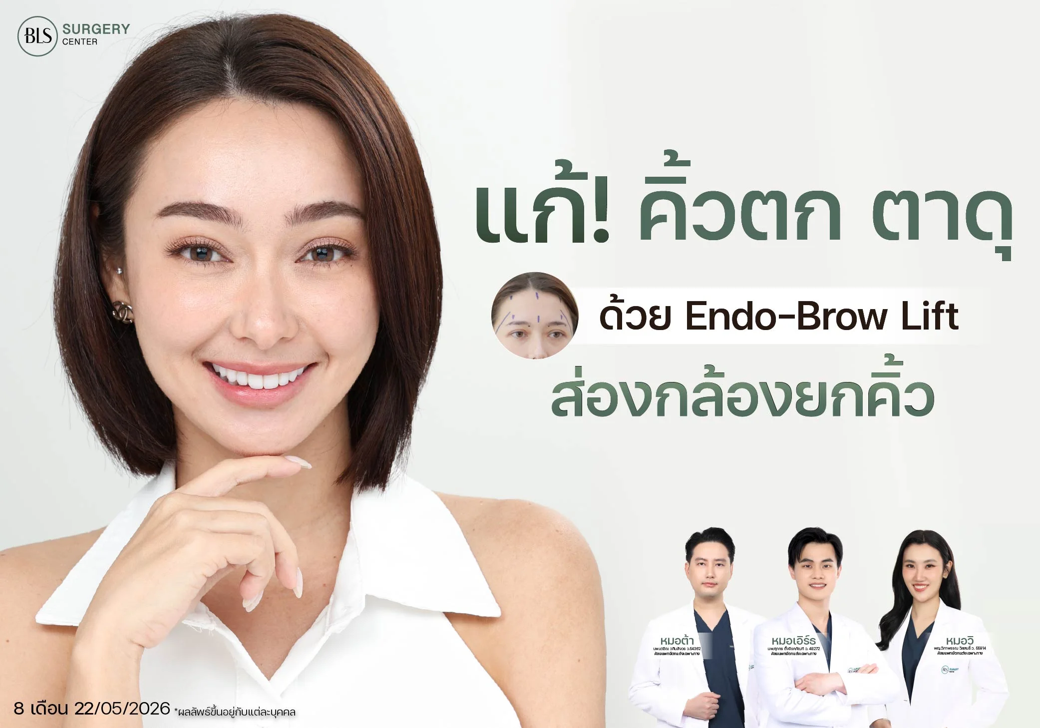 ผ่าตัดยกคิ้ว แก้คิ้วตก ตาดุ ด้วย Endo-Brow Lift ส่องกล้องยกคิ้ว