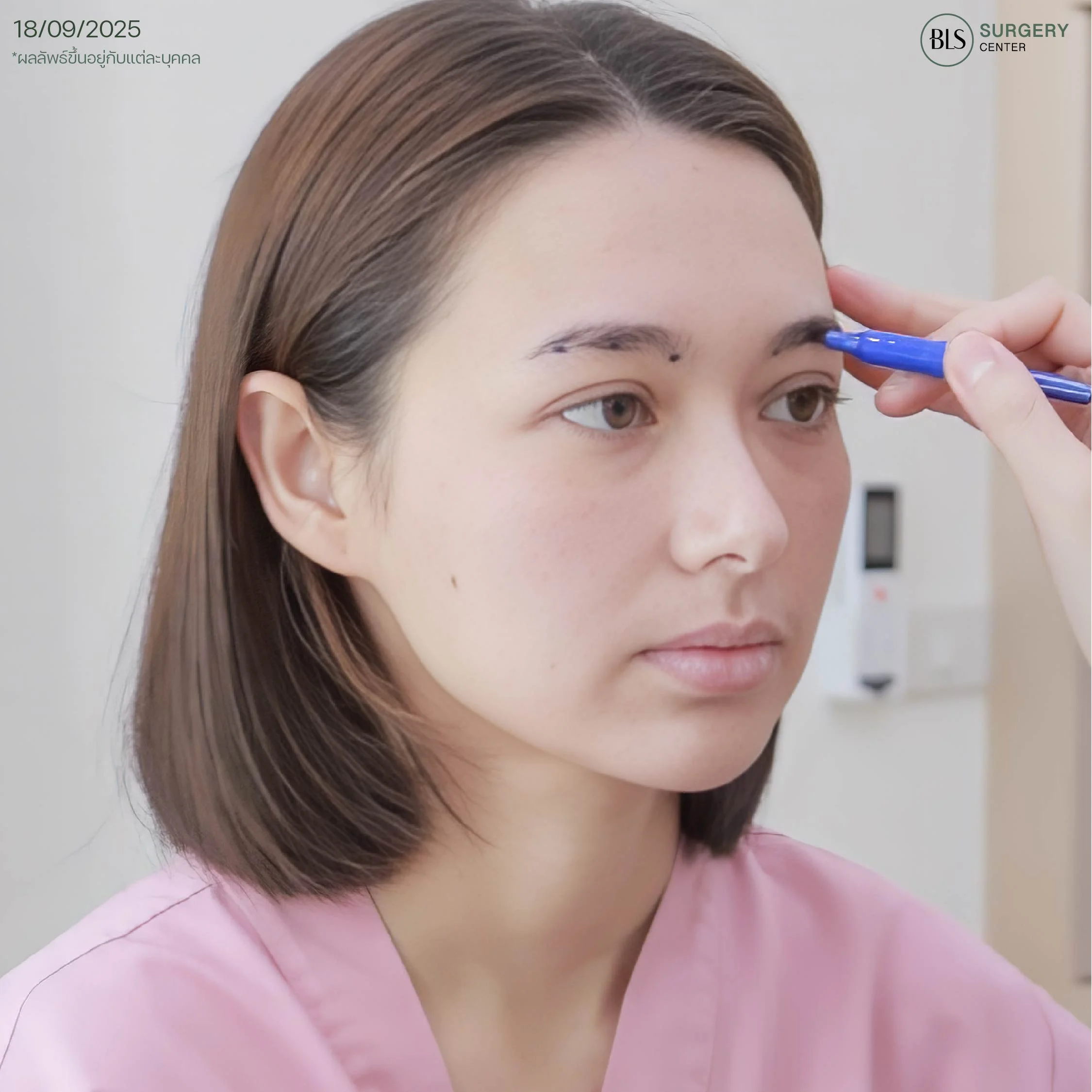 ประเมินปัญหา พร้อมออกแบบการยกคิ้ว ยกหางตา และบริเวณหน้าผากโดยหมอ BLS Surgery Center