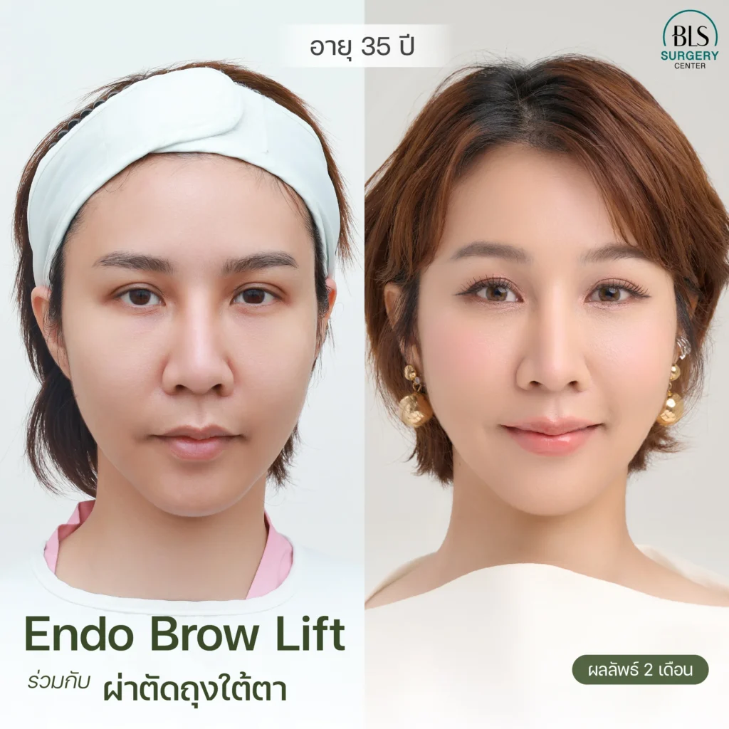 Review of Endo-Brow Lift and lower eyelid bag removal surgery cases.