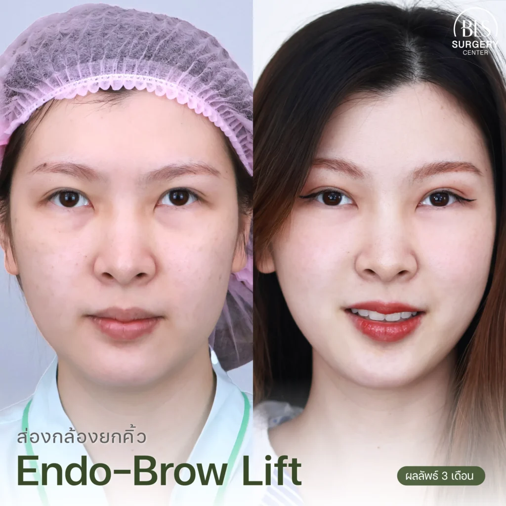 รีวิวแก้คิ้วตก ตาตก ส่องกล้องยกคิ้ว (Endo-Brow Lift)