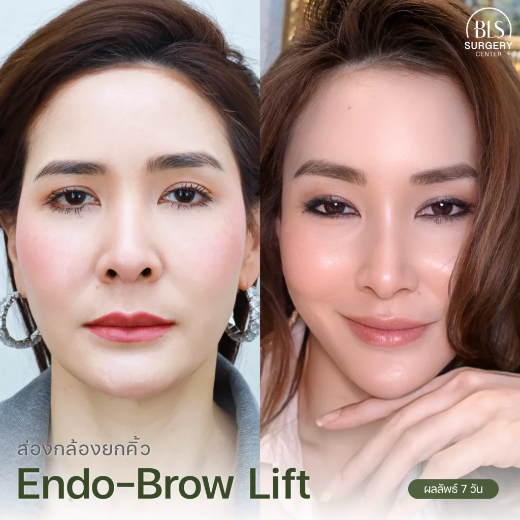 รีวิวแก้คิ้วตก ตาตก ส่องกล้องยกคิ้ว (Endo-Brow Lift)