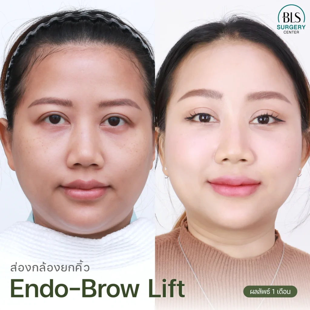 รีวิวแก้คิ้วตก ตาตก ส่องกล้องยกคิ้ว (Endo-Brow Lift)