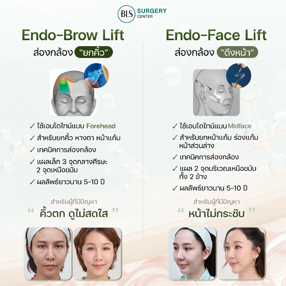 Endo-Face Lift ส่องกล้องดึงหน้า และคิ้ว