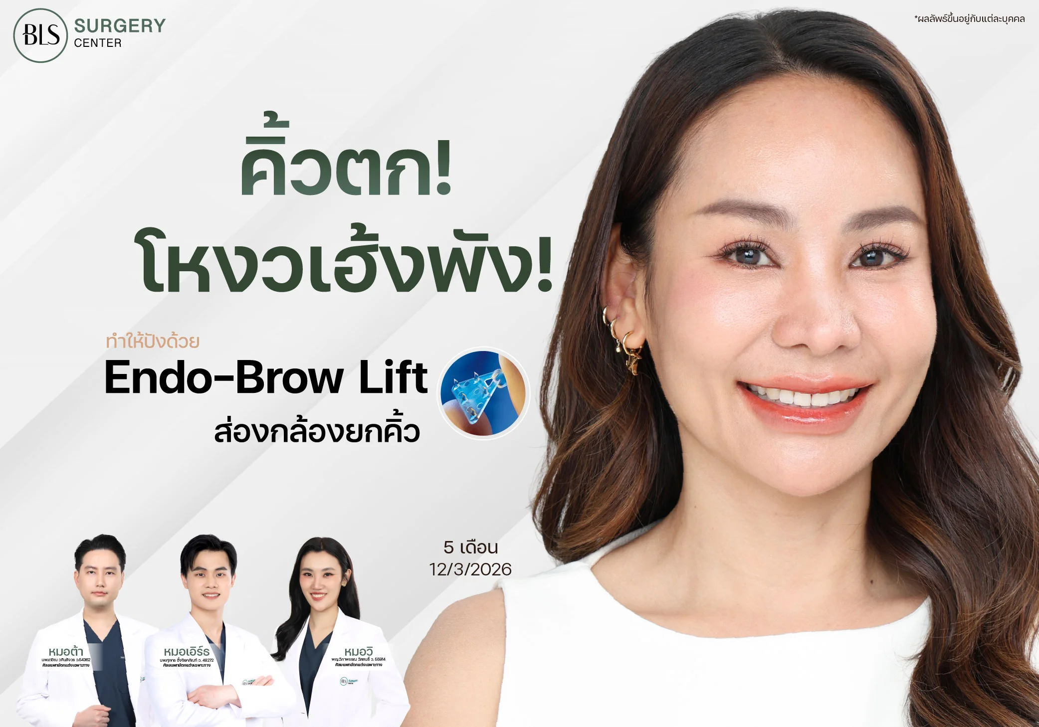 คิ้วตก แก้ยังไง? ยกคิ้วเอนโดไทน์ คืออะไร? ได้ผลจริงไหม?