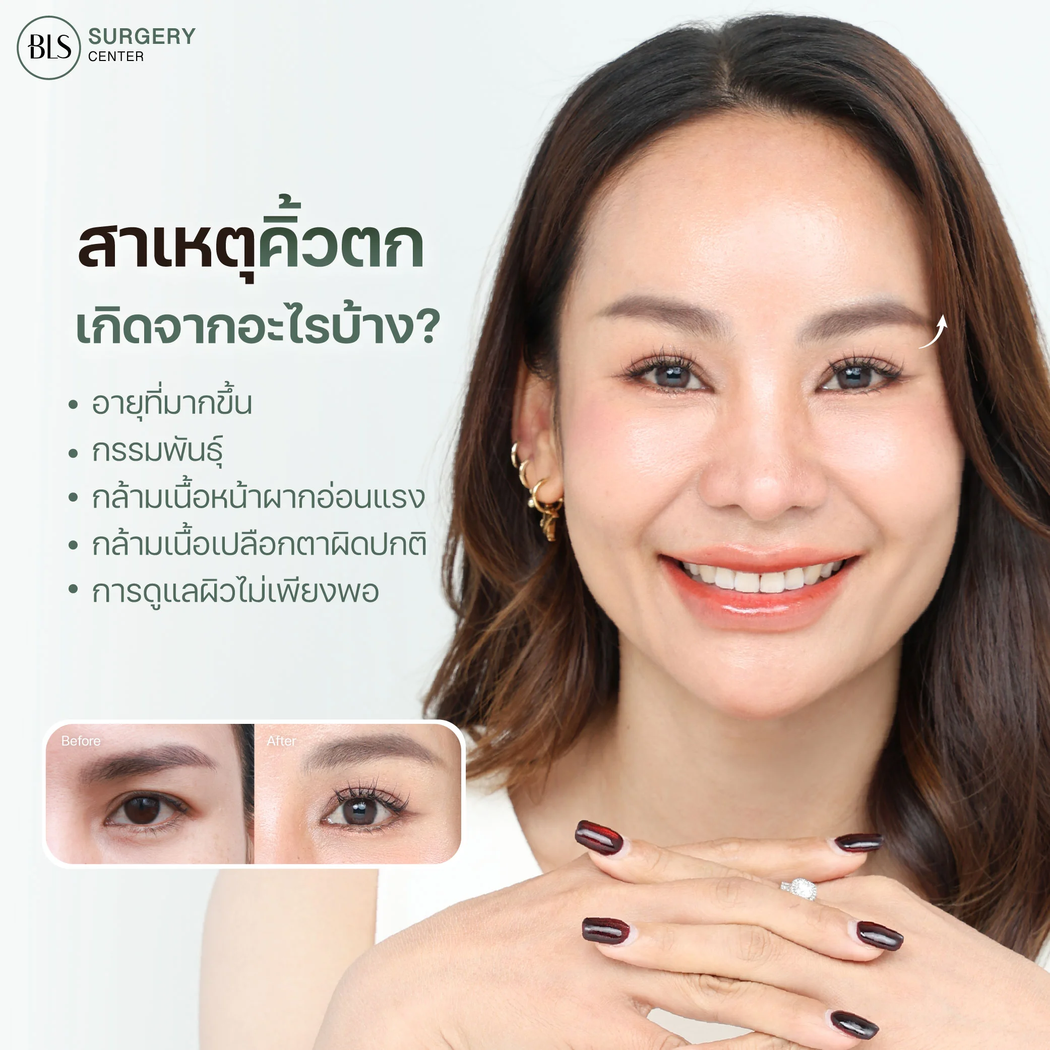 สาเหตุของคิ้วตก เกิดจากอะไร? ส่งผลเสียอย่างไรต่อใบหน้า?