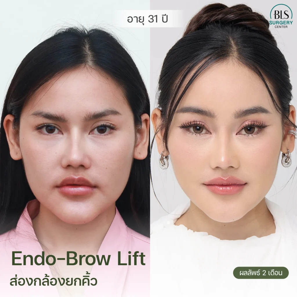 รีวิวยกคิ้ว Endotine (Endo-Brow Lift) สวยๆ ที่ BLS Surgery Center