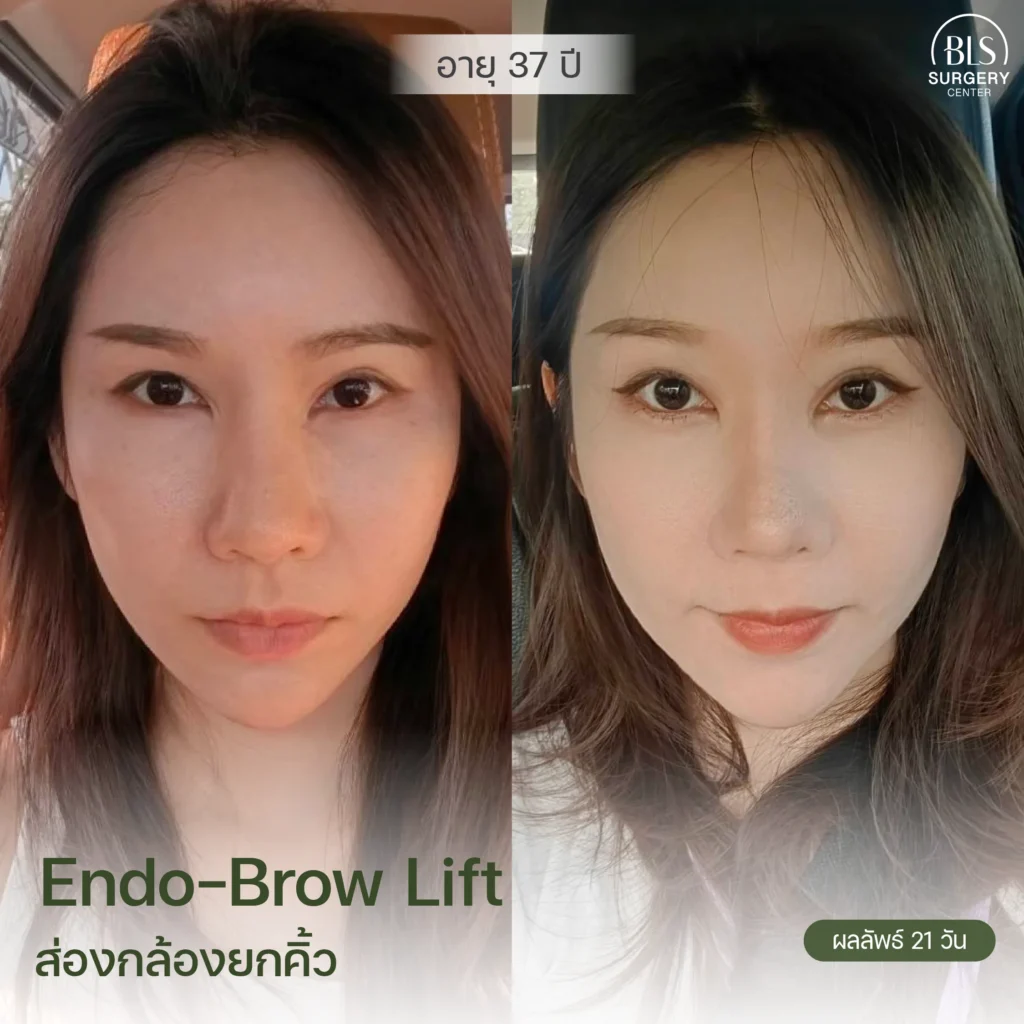 รีวิวยกคิ้ว Endotine (Endo-Brow Lift) สวยๆ ที่ BLS Surgery Center