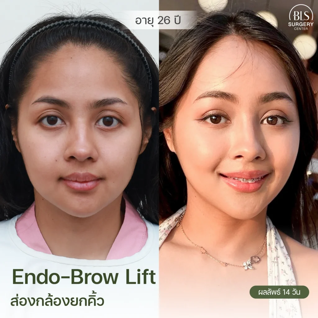 รีวิวยกคิ้ว Endotine (Endo-Brow Lift) สวยๆ ที่ BLS Surgery Center