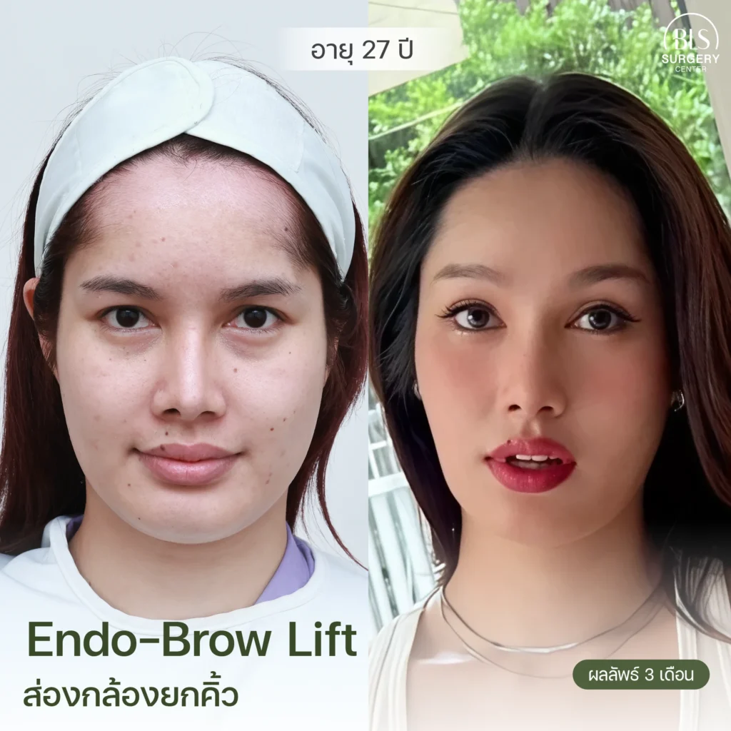 รีวิวยกคิ้ว Endotine (Endo-Brow Lift) สวยๆ ที่ BLS Surgery Center