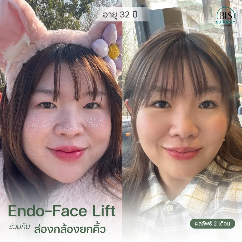 รีวิวยกคิ้ว Endotine (Endo-Brow Lift) สวยๆ ที่ BLS Surgery Center