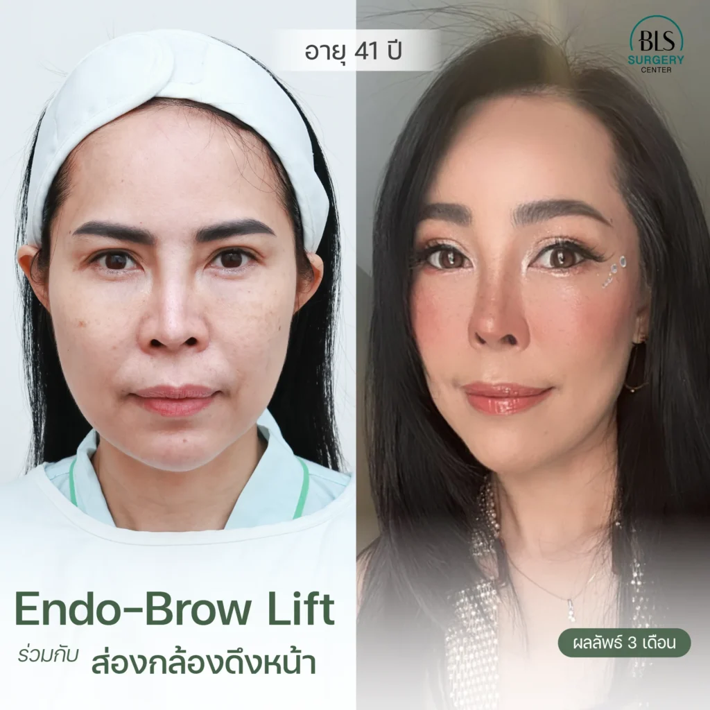 รีวิวยกคิ้ว Endotine (Endo-Brow Lift) สวยๆ ที่ BLS Surgery Center